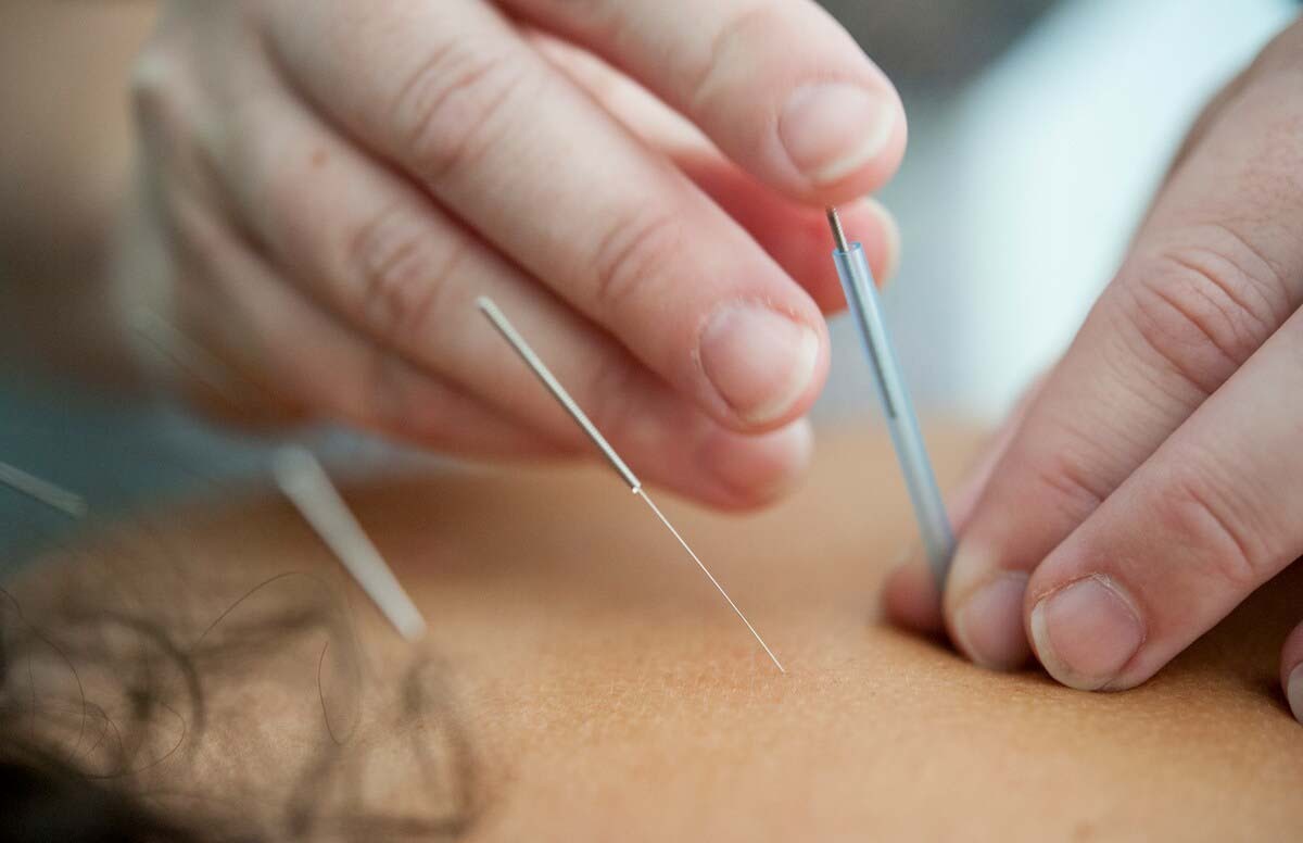 Acupuncture Bed